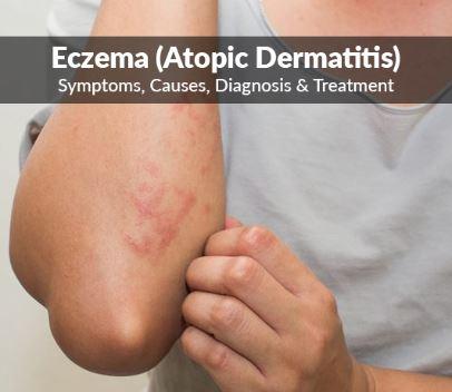 (Eczema) Symptoms treatment and causes of Eczema (Eczema) Symptoms treatment and causes of Eczema