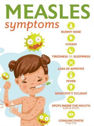 Measles (Sarampión) Treatment Symptoms Measles (Sarampión) Treatment Symptoms