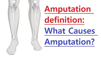 Amputation definition: What Causes Amputation? Amputation definition: What Causes Amputation?