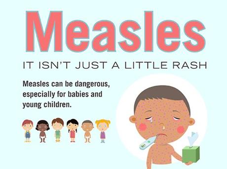 Measles - Symptoms and causes Measles - Symptoms and causes