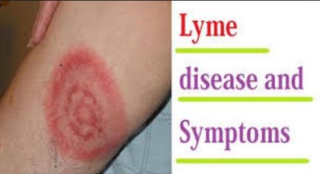 Lyme disease: What are the symptoms of Lyme disease? Lyme disease: What are the symptoms of Lyme disease?