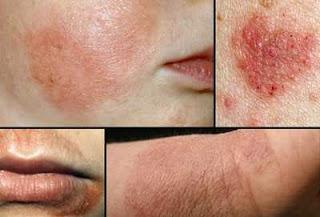 Methods To Deal With Eczema By Dermatologists in Mumbai