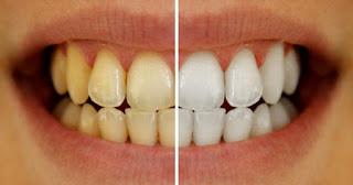 Methods To Remove Yellow Teeth By Dentists in Coimbatore