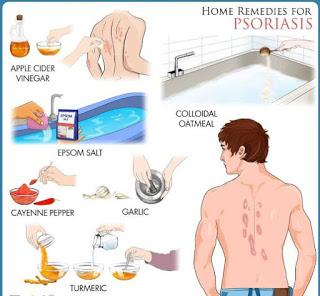 Which Are The Best Psoriasis Home Remedies?