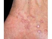 Best Home Remedies Scabies