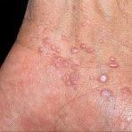 Best Home Remedies for Scabies