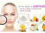 Home Remedies Acne Scars: Scars Naturally?