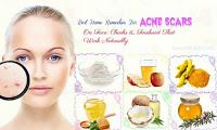Home Remedies for Acne Scars