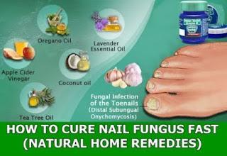 Toenail Fungus Home remedies