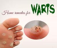 Homemade Wart Treatment 