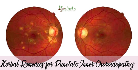 Herbal Remedies for Punctate Inner Choroidopathy