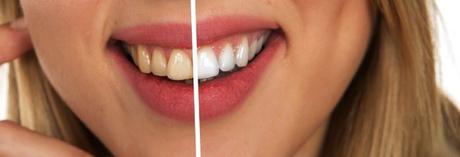 Natural Tips for Teeth Whitening