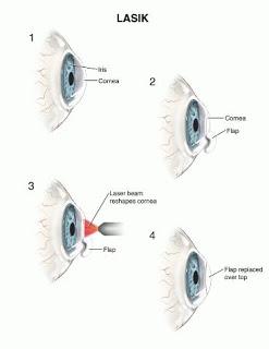 Lasik Surgery For Presbyopia