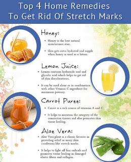 stretch marks removal, stretch marks from pregnancy, stretch marks get rid of, stretch marks treatment, stretch marks losing weight,