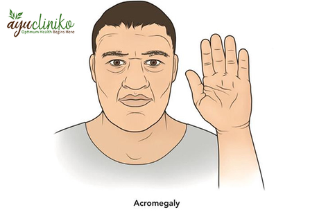Can Acromegaly Be Treated by Ayurveda?