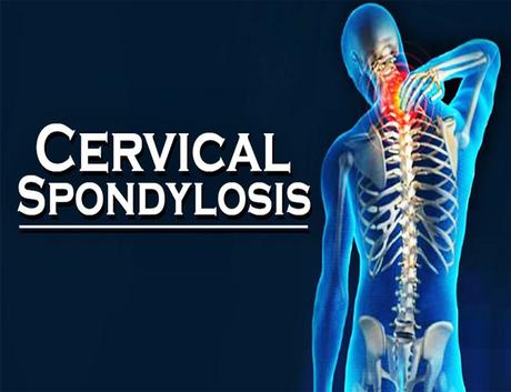 How to Treat Cervical Spondylosis with Ayurveda