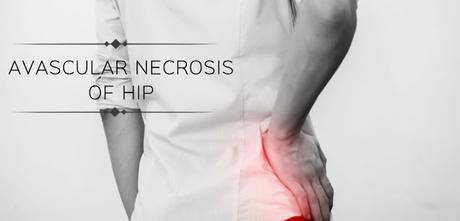 Find Out The Factors Triggering Avascular Necrosis in Hip