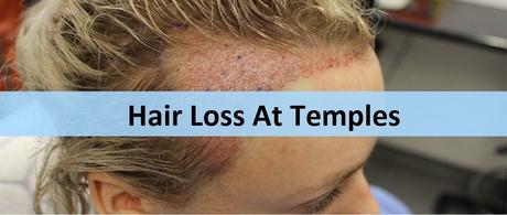 Hair Thinning At Temples – What You Can Do About It