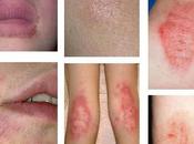 Best Herbal Remedies Fungal Diseases