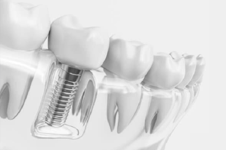 Zirconia Implants – Essentials You Need to Know About It