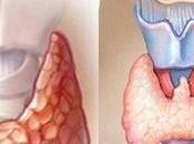 Treat Hypothyroidism Naturally with Herbal Remedies