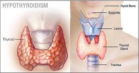 How to Treat Hypothyroidism Naturally with Herbal Remedies