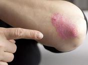 Best Remedy Soothe Eczema Without Prescription