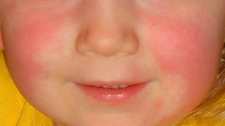 New strain of Strep A causing scarlet fever, invasive infections in parts of U.K.: study