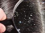 Fight Your Dandruff With Ayurveda Remedies Doctors