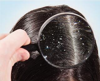 Fight Your Dandruff With Ayurveda - Remedies By Doctors