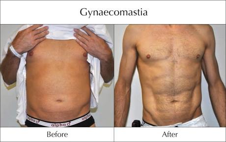 Top Myths About Gynecomastia Surgery in India Top Myths About Gynecomastia Surgery in India
