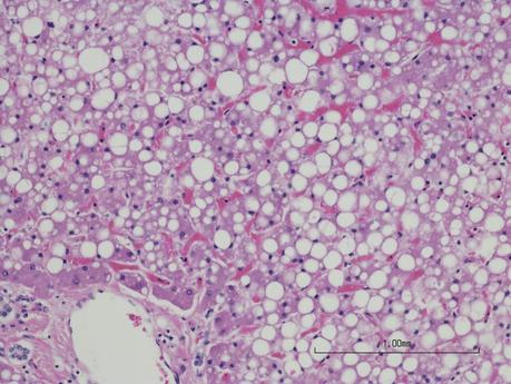 Gut bacteria converting carbs into alcohol may contribute to fatty liver disease Gut bacteria converting carbs into alcohol may contribute to fatty liver disease