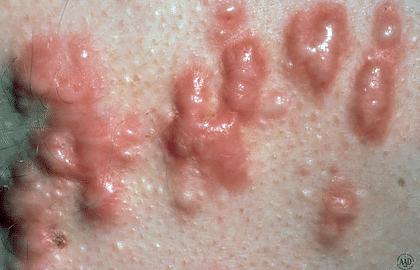HOW TO TREAT KELOID IN AYURVEDA?