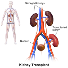 Kidney Transplant Treatment