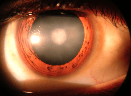 Cataract – Causes, Symptoms and Treatment
