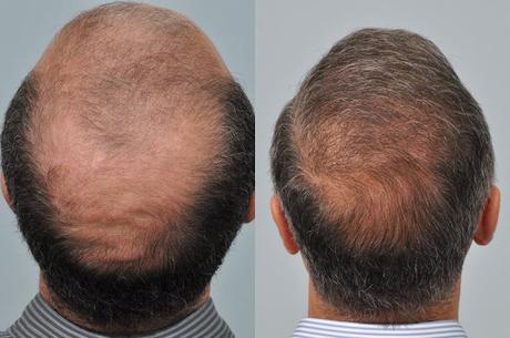 Crown Hair Transplant AT Hair Transplant Dubai Clinic