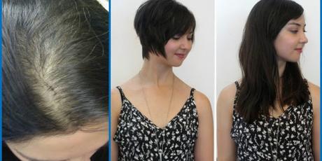Regrow Hairs With Onion Juice