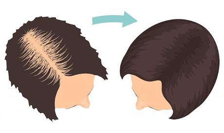 How to find the best surgeon for female hair transplant?