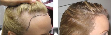 How to find the best surgeon for female hair transplant?