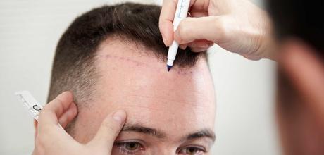 Trusting Hair Transplantation as a Solution for Hair Loss