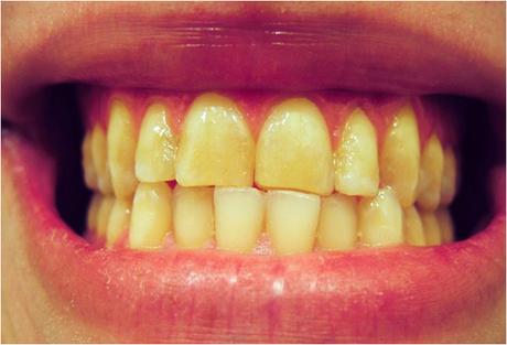 How To Whiten Your Teeth With Ayurveda?