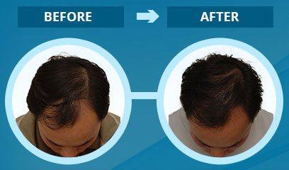 Is Procerin A Good Hair Loss Product? Unbiased Review