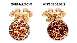 Treatment of Osteoporosis  with Food Supplements
