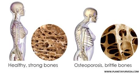 Treatment of Osteoporosis  with Food Supplements
