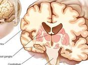 Supranuclear Palsy,Causes,Diagnosis,Symptoms Treatment Ayurveda