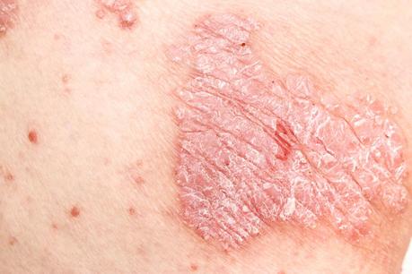 best remedies that psoriasis