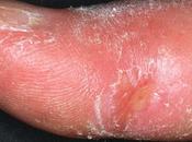 Diffused Systemic Sclerosis Treatment Ayurveda