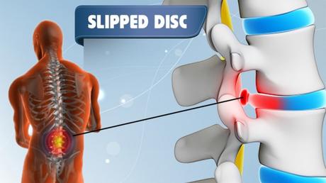 Treatment of Slipped Disc in Ayurveda
