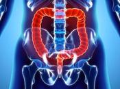 What Symptoms, Causes, Diagnosis Best Alternative Treatment Pancolitis?