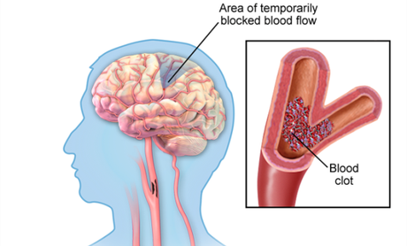 How to Manage TIA (Transient Ischemic Attack) With Ayurveda?